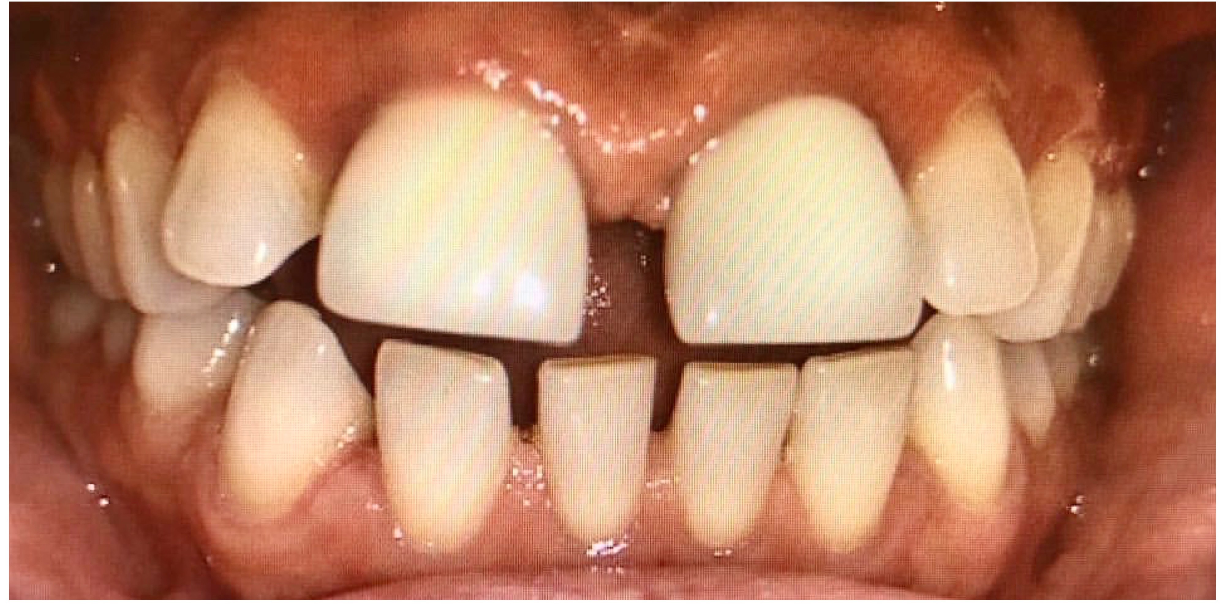 Teeth with gap before Invisalign